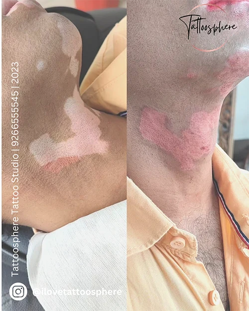 Vitiligo Cover Up/Treatment